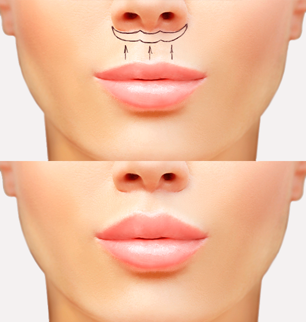 LIPLIFT