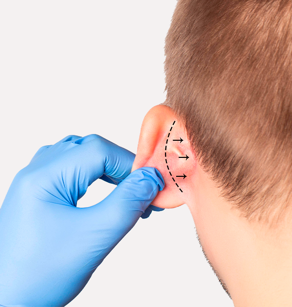 OTOPLASTIA