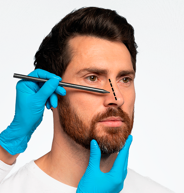 Rinoplastia